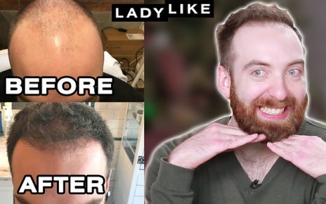 Here's What Hair Looks Like One Year After A Robotic Hair Transplant